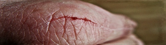 Infection par griffure de l'articulation