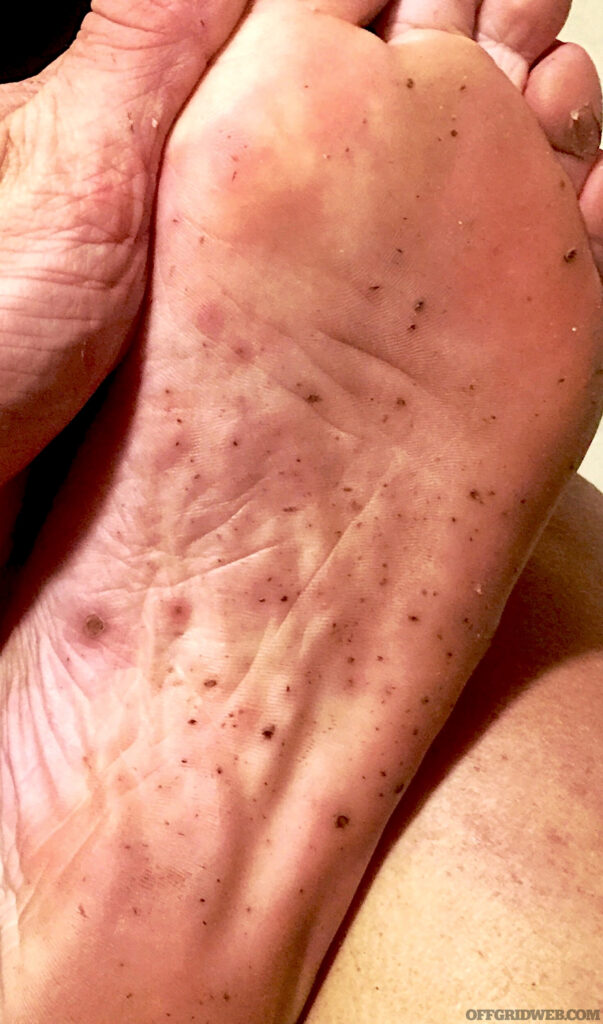 Photo de la partie inférieure du pied de Melissa Millers qui a été agressivement piquée par des insectes.
