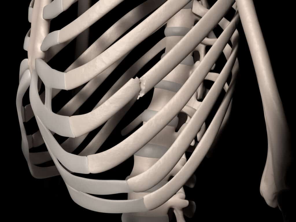 Illustration médicale numérique représentant une fracture de la 7e côte (côte vraie, côte vertébro-sternale, costa vera). Vue de face.